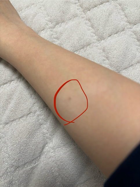 팔목쪽에 이상한 검은색 점 같은게 있어요의 0번 째 이미지