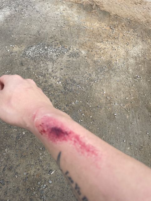 현장 타박상 사고 보상및 처리 방법 제가 해야되는 것들의 0번 째 이미지