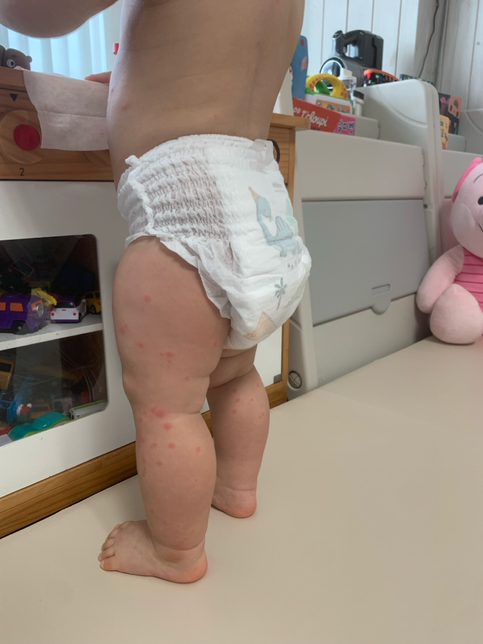 16개월애기 두드러기인지 수두인지 궁굼하네요 ㅠㅠㅠ의 0번 째 이미지