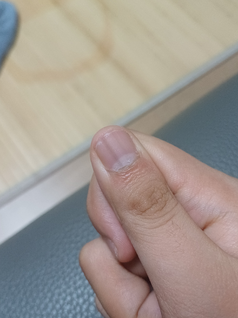 손가락의 검은 선은 뭔가요? 흑색종인가요?의 1번 째 이미지