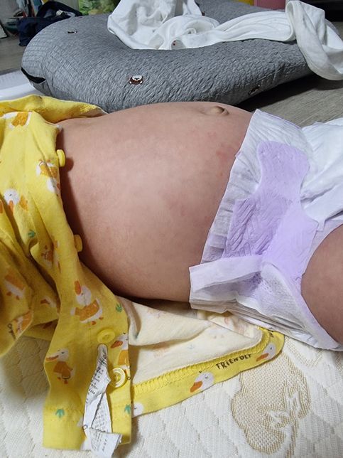 50일 아기 배가 불뚝하고 단단한데 정상인지?의 0번 째 이미지