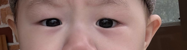 9개월 아기 눈 안검하수 일까요?의 3번 째 이미지