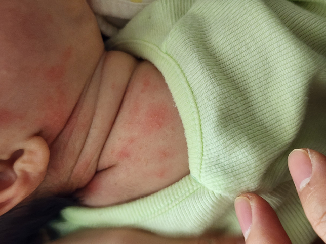 아기 목과 얼굴 쪽에 번지는 것이 태열일까요? 땀띠인가요? 아님 다른 병일까요?의 1번 째 이미지