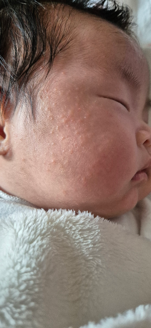 30일정도된 아기 얼굴에 오돌도돌 뭔가 났는데 피부과를 가봐야 할까요?의 0번 째 이미지