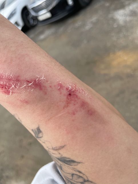 현장 타박상 사고 보상및 처리 방법 제가 해야되는 것들의 1번 째 이미지