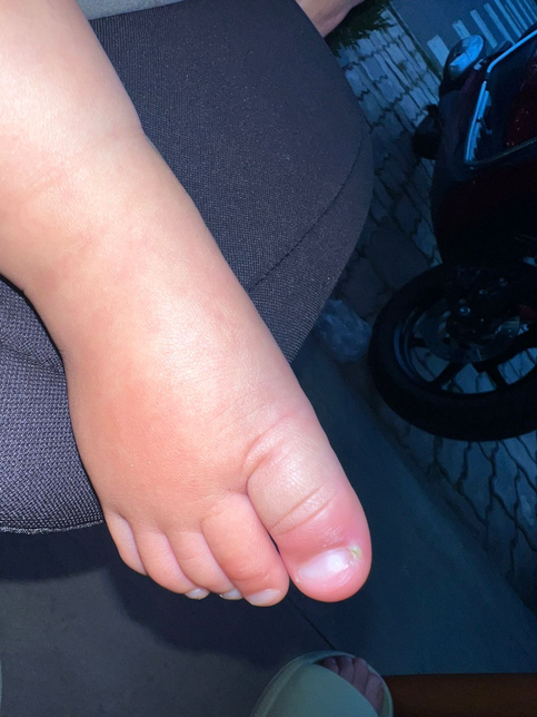 아기 엄지 발가락 옆에 물집 같은게 났는데 이거 괜찮을까요??의 0번 째 이미지