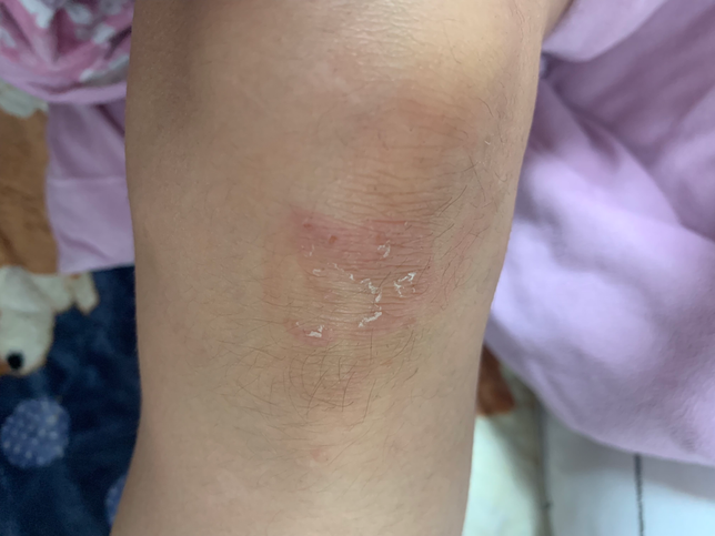 습진인지 무좀인지 알수있을까요?의 3번 째 이미지