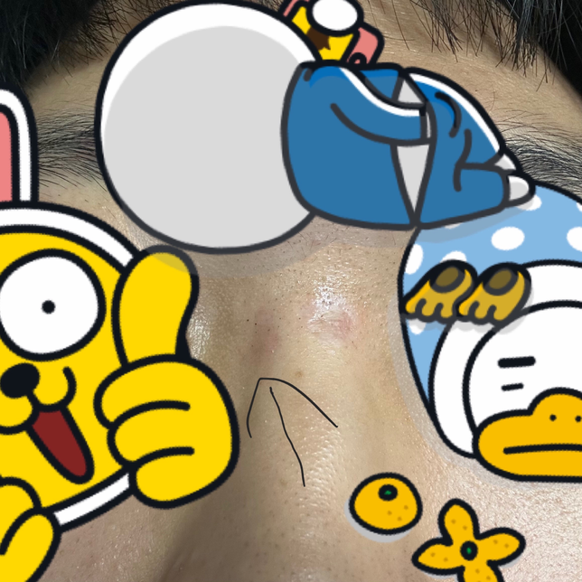 상처 아문 후 붉은기 어떻게 해야할까요?의 0번 째 이미지