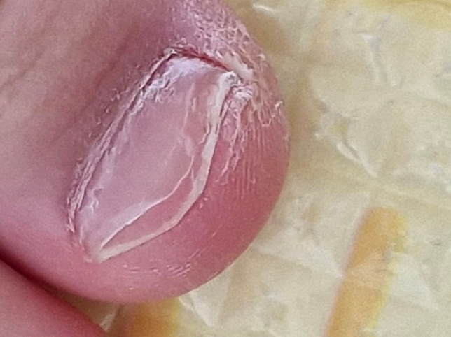 19개월 아기발톱이 왜이렇게 될까요?의 0번 째 이미지