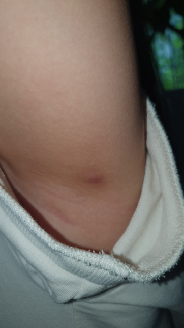 7살 겨드랑이에 벌레물린건지 뭔지 모르겠어요의 0번 째 이미지