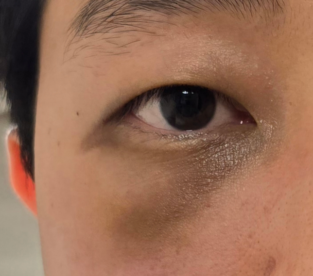 보라색 멍이 침착되어 갈색멍이 되었습니다. 본래 피부색으로 돌아올까요?의 0번 째 이미지