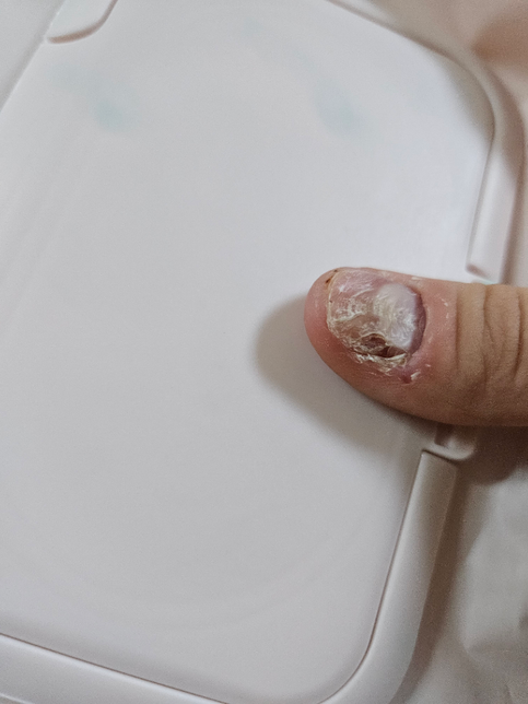 아이 손톱이 이런데 어디를 가야할까요?의 0번 째 이미지