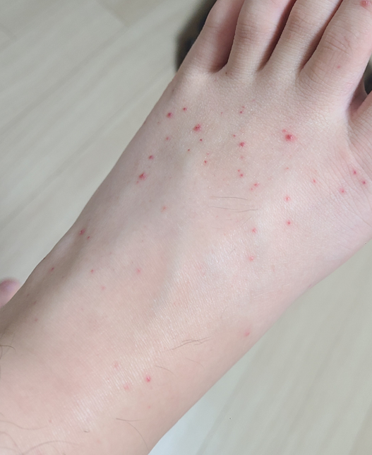 발등 피부에 열꽃이 생겼어요 자빈증인가요?의 0번 째 이미지