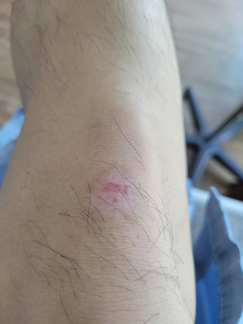 찰과상 흉터 연고 추천 부탁드립니다의 0번 째 이미지