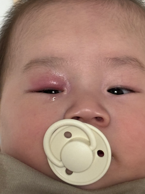 아기눈 왜이런가요? 병원에선 다래끼 결막염이 아니래요의 0번 째 이미지