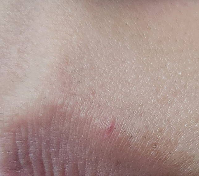 입술에 두드러기 올라온 이후 저렇게 빨갛게 남았는데 .,의 0번 째 이미지