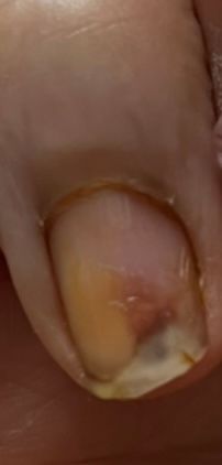 네일샵에서 상해를 입었는데 보상받을수있나요?의 0번 째 이미지