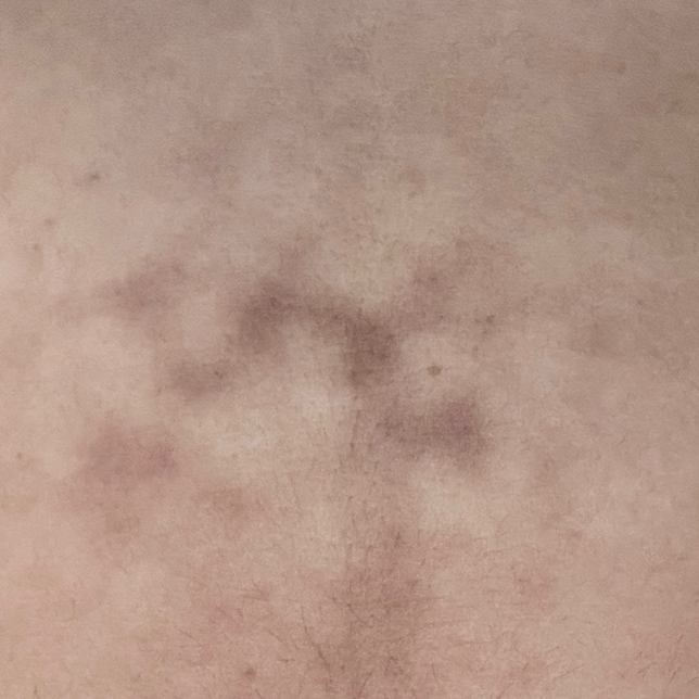 배에 저온화상 입었는데 어떻게 하면 괜찮아질까요?의 0번 째 이미지