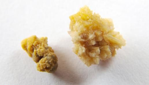 요로결석 수술, 꼭 해야 하나요? 체외충격파랑 뭐가 다른 건가요?