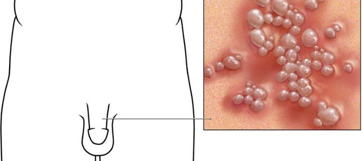 성기에 물집이나 상처가 생겼을 때, 헤르페스일까요 매독일까요? 꼭 구분해야 하는 6가지 질환.