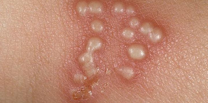 생식기에 물집이 생겼는데… 헤르페스일까요?