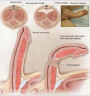발기 시 음경이 휘어집니다. 치료가 필요한 음경만곡증일까요?